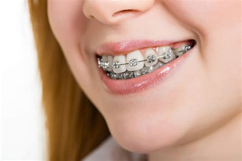 de que están hechos los brackets de metal|Brackets metálicos: qué son, tipos y su precio.